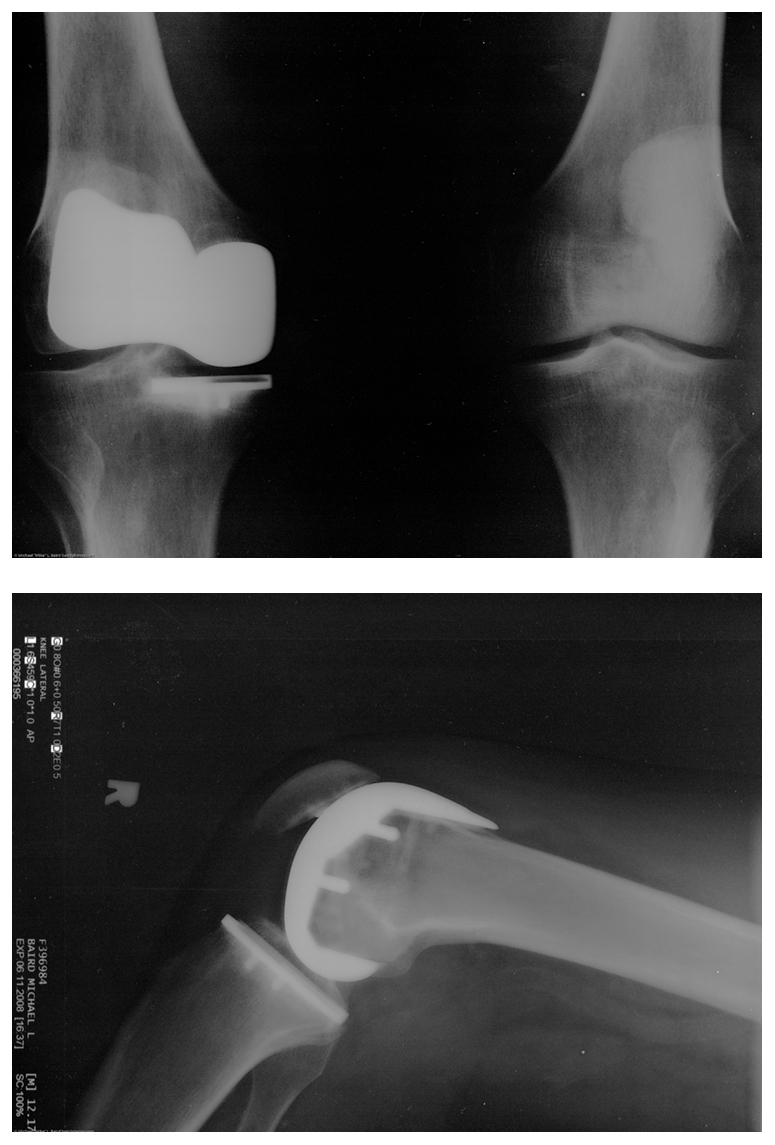 Two X-rays of an artificial knee replacement are shown.